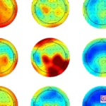 Adult ADHD trial results