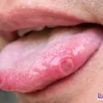 kanker lidah penyebab dan gejala