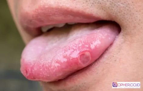 kanker lidah penyebab dan gejala