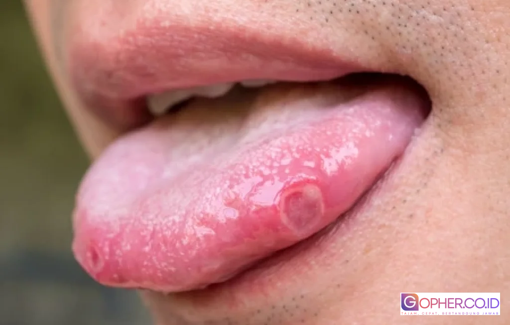 kanker lidah penyebab dan gejala