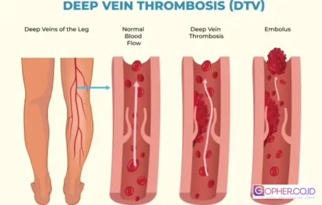 obat osteoporosis turunkan risiko demensia