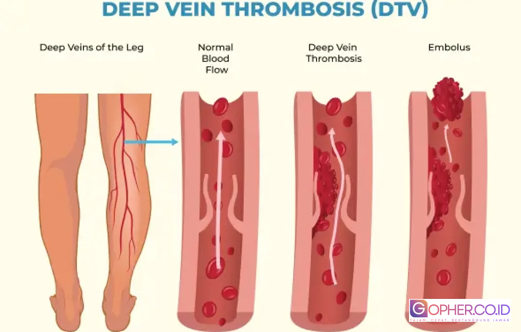 obat osteoporosis turunkan risiko demensia