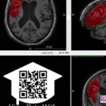 open data stroke recovery