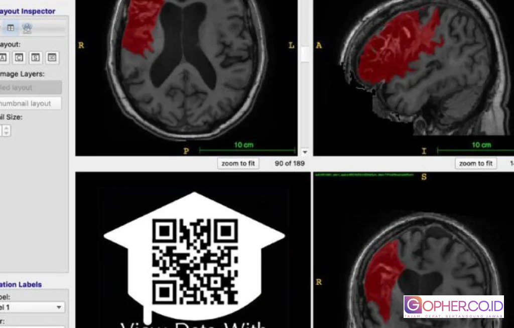open data stroke recovery