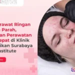perawatan jerawat ringan hingga parah