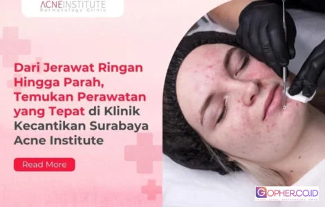 perawatan jerawat ringan hingga parah